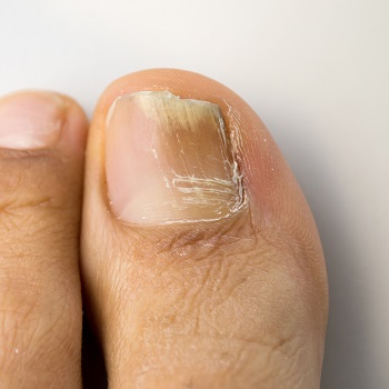 Foot Infection Symptoms, Treatment & Causes | Push Doctor