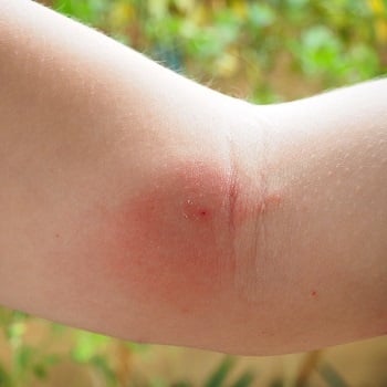 Insect Bites Symptoms, Prevention and Treatment | Push Doctor