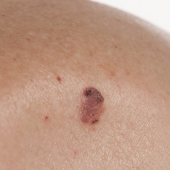 Melanoma Symptoms & What Causes Melanoma to appear | Push Doctor