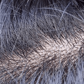 Itchy Scalp Reasons & Treatment | Push Doctor